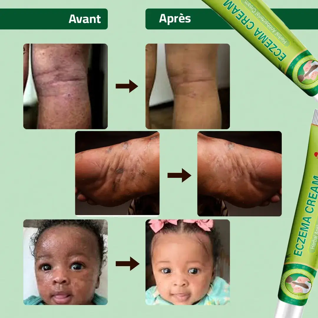 Crème anti-démangeaison : votre solution contre l’eczéma et l'irritation !