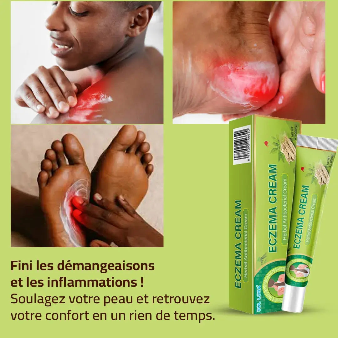 Crème anti-démangeaison : votre solution contre l’eczéma et l'irritation !