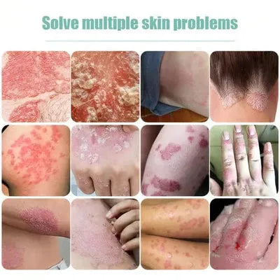 Crème anti-démangeaison : votre solution contre l’eczéma et l'irritation !